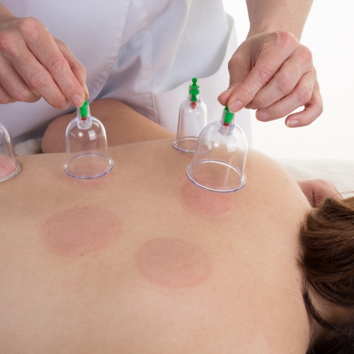 physiotherapy-center-cupping-expert-physio-plus-gloucester-orleans-on