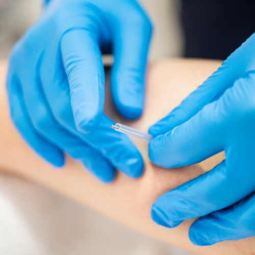 physiotherapy-center-dry-needling-expert-physio-plus-gloucester-orleans-on